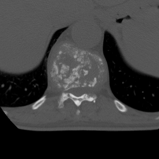 Viêm đốt sống do lao (Tuberculous spondylitis)