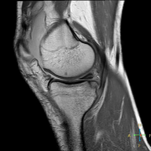 Gãy bong điểm bám đầu xa gân cơ bán mạc (Semimembranosus distal tendon avulsion)