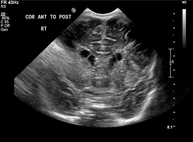 Nang connatal (Connatal cyst)