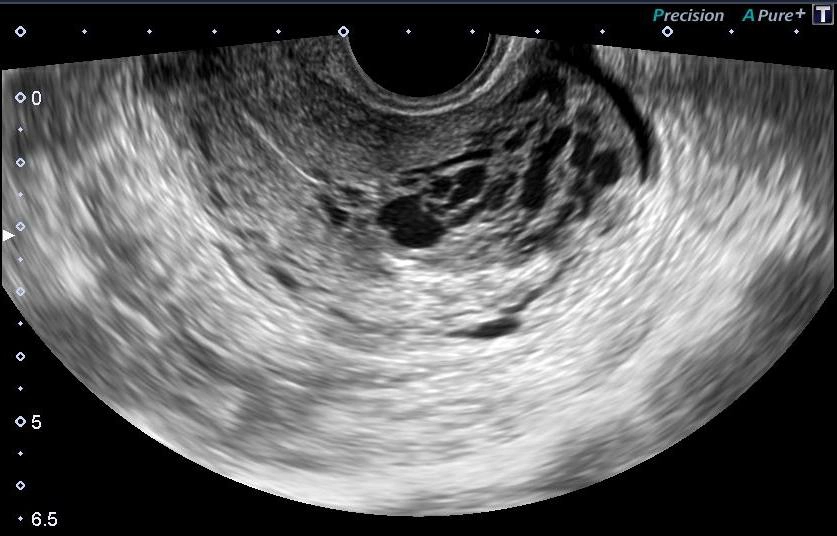Dị dạng động tĩnh mạch tử cung (Uterine Arteriovenous Malformation - AVM)