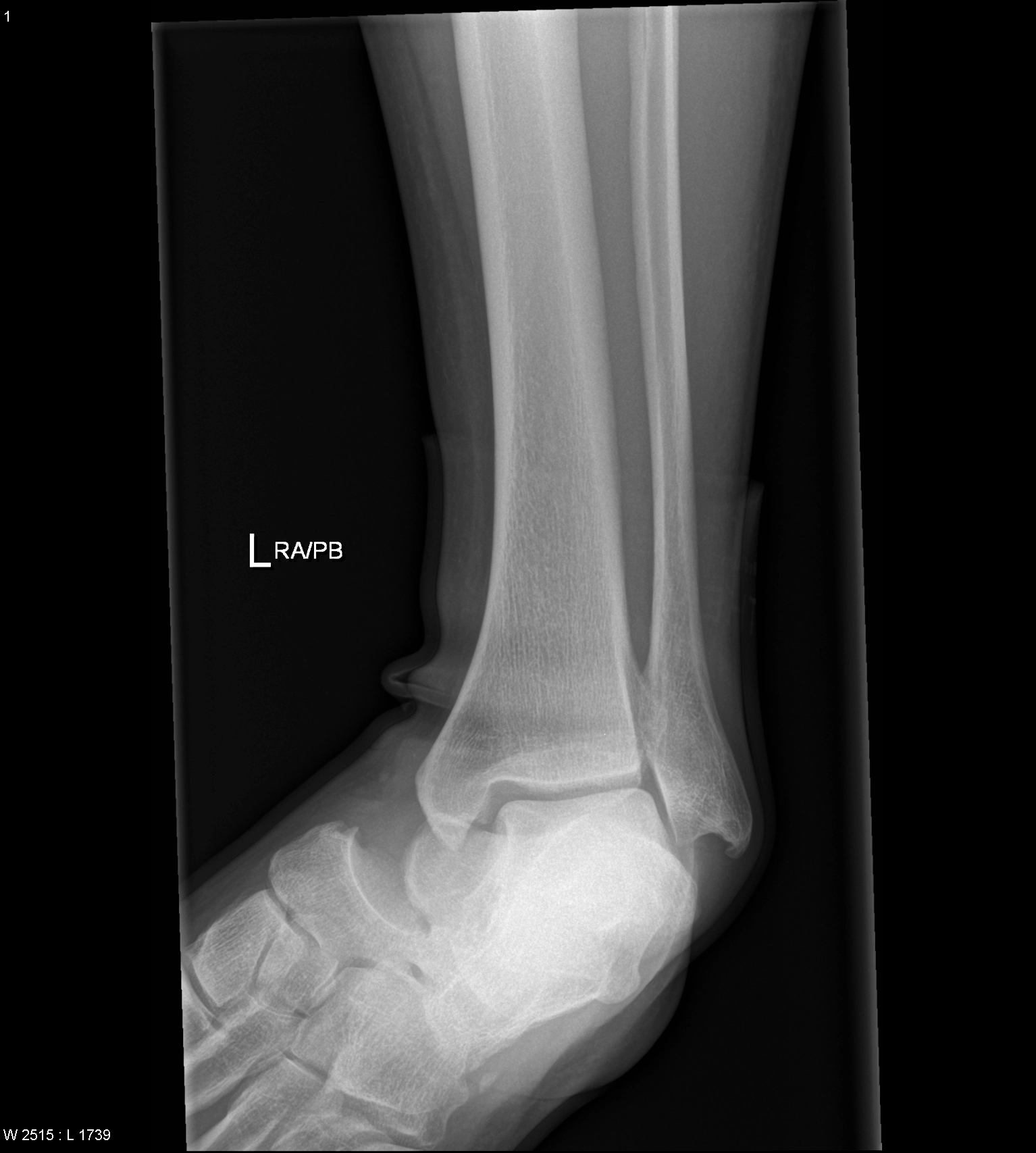 Trật khớp dưới sên (Subtalar Dislocation)