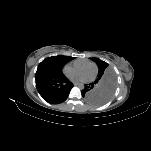 Nhiễm sán dải chó ở phổi (Pulmonary hydatid infection)