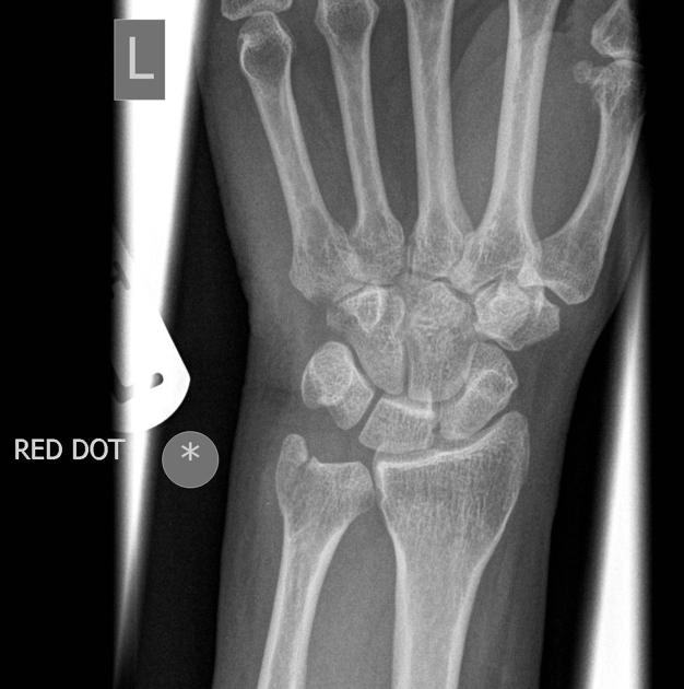 Gãy mỏm trâm trụ (Ulnar styloid fracture)