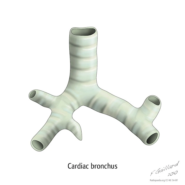 Biến thể phế quản tim (Cardiac bronchus)