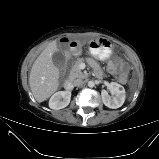 Bánh mạc nối (Omental cake)