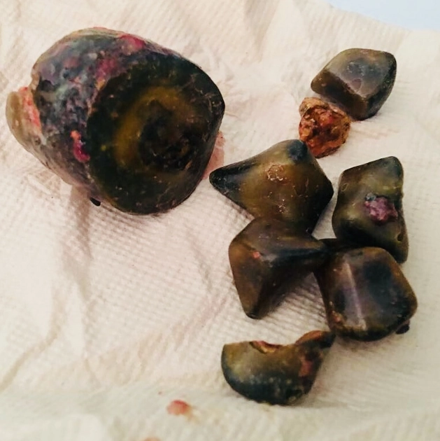 Sỏi túi mật (Gallstones)