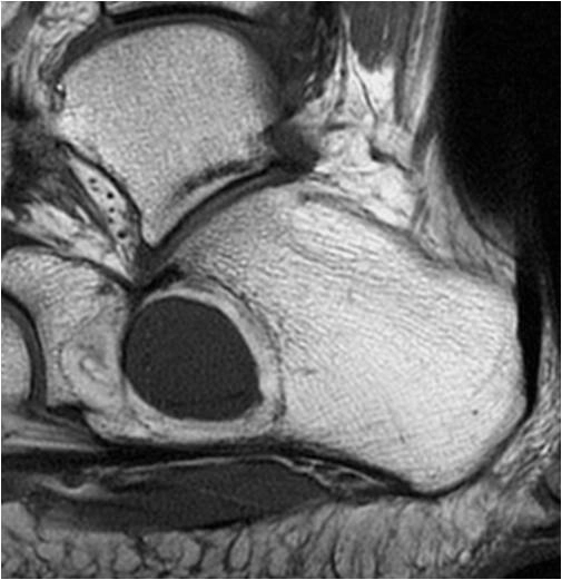 U mỡ trong xương (Intraosseous lipoma)