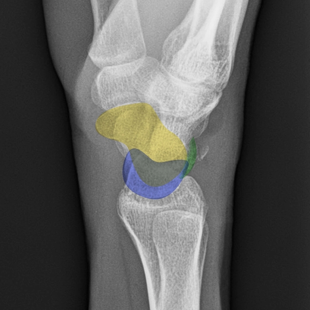 Gãy xương tháp (Triquetral fracture)