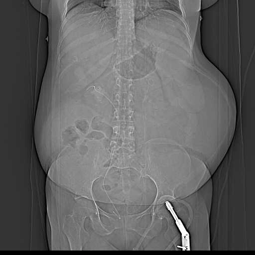 Vỡ niệu quản (Ureteric rupture)