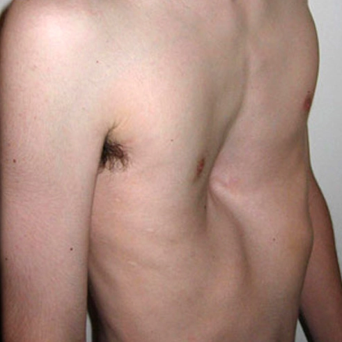 Lồng ngực lõm (Pectus Excavatum)