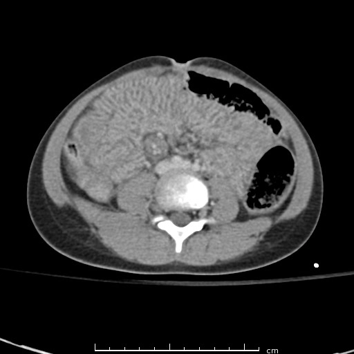 Sốc ruột (Shock bowel)