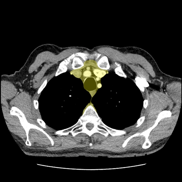 Giải phẫu CT trung thất và mô mềm