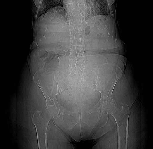 Xoắn lách (Splenic volvulus)