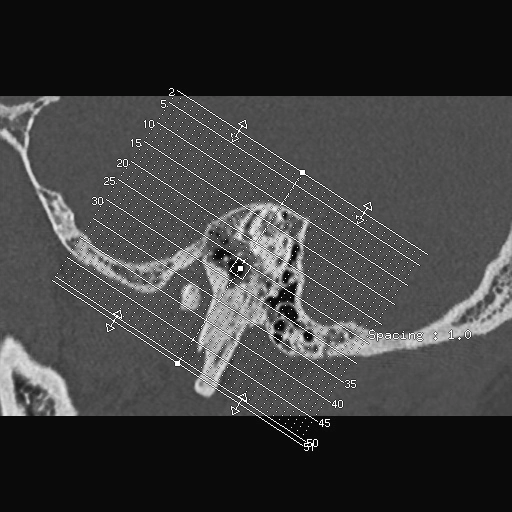 Chồi xương ống tai ngoài (External auditory canal exostoses)