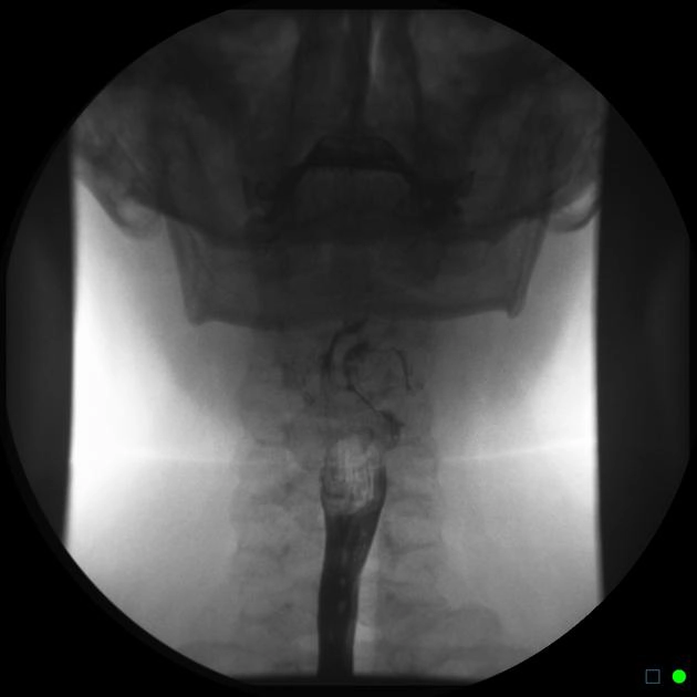 Ung thư biểu mô tế bào vảy hạ hầu (Hypopharyngeal squamous cell carcinoma)