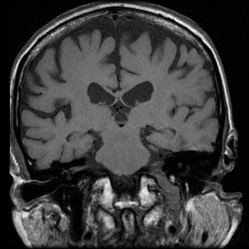 Schwannoma lỗ tĩnh mạch cảnh (Jugular foramen schwannomas)