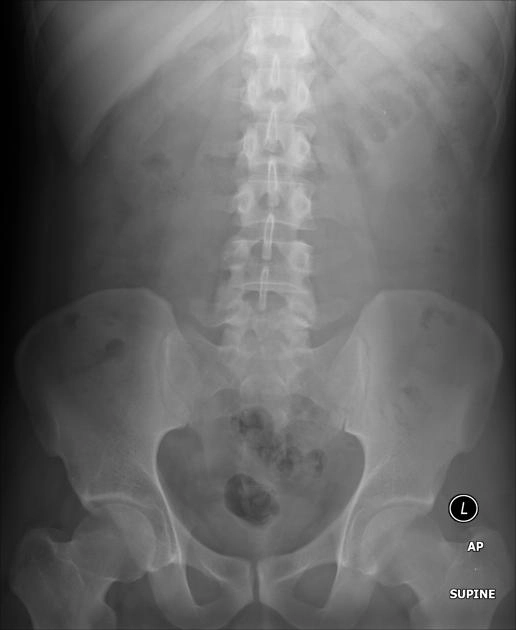 Tật nứt đốt sống (Spina bifida)