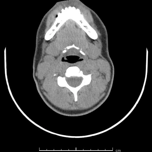 Nang bì vùng dưới hàm (Submandibular dermoid cyst)
