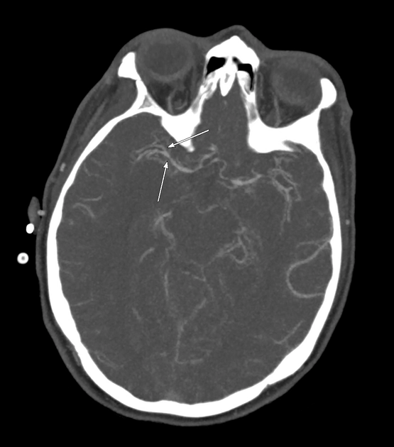 Co thắt mạch não sau xuất huyết dưới nhện (Cerebral vasospasm following subarachnoid hemorrhage)