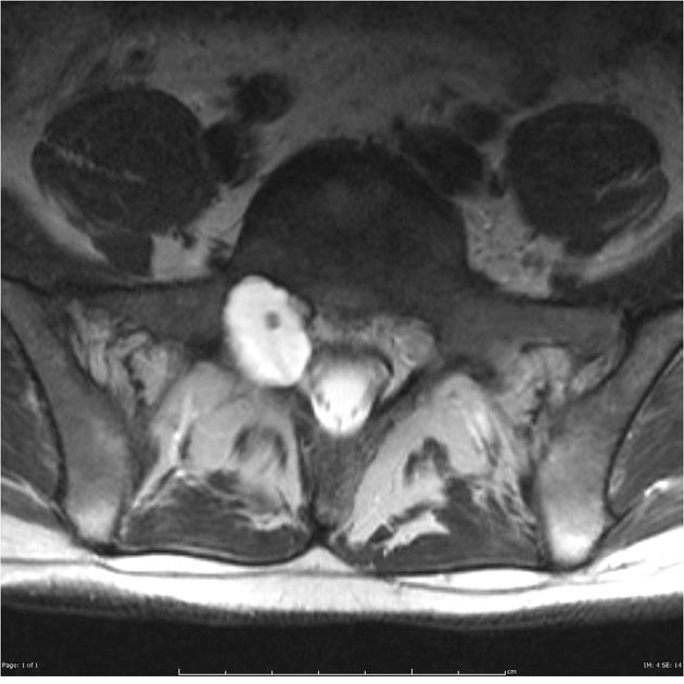Các nang màng tủy cột sống (Spinal meningeal cysts)