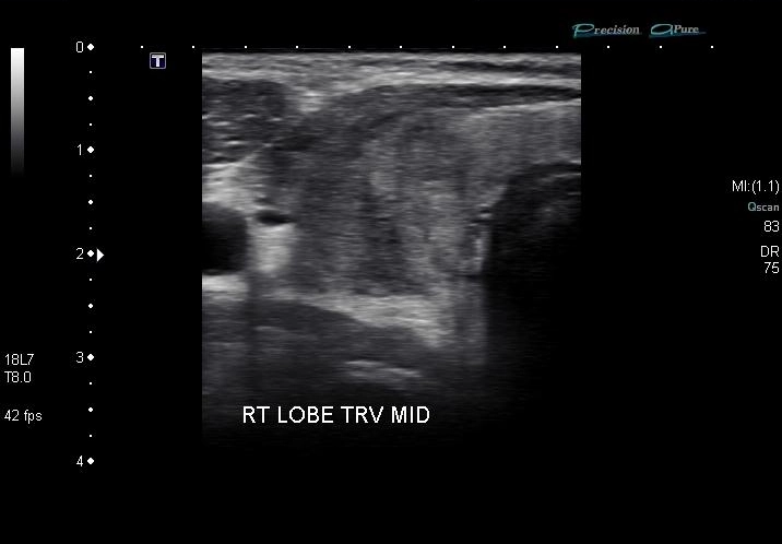 Viêm tuyến giáp bán cấp De Quervain (De Quervain thyroiditis)