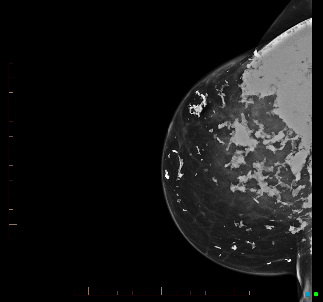 Vôi hóa loạn dưỡng (Dystrophic calcification within the breast)