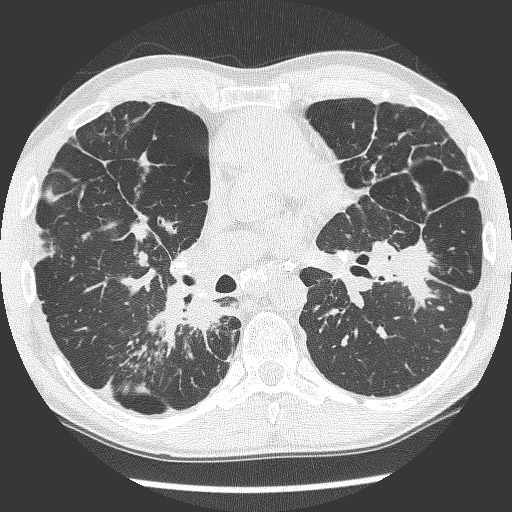 Tổn thương quanh mạch máu- phế quản  (Peribronchovascular)