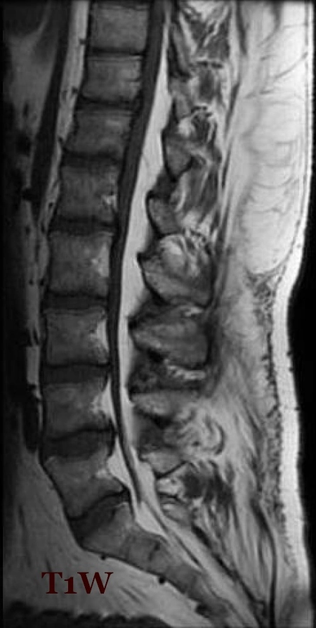 Ứ đọng mỡ ngoài màng cứng (Epidural lipomatosis)