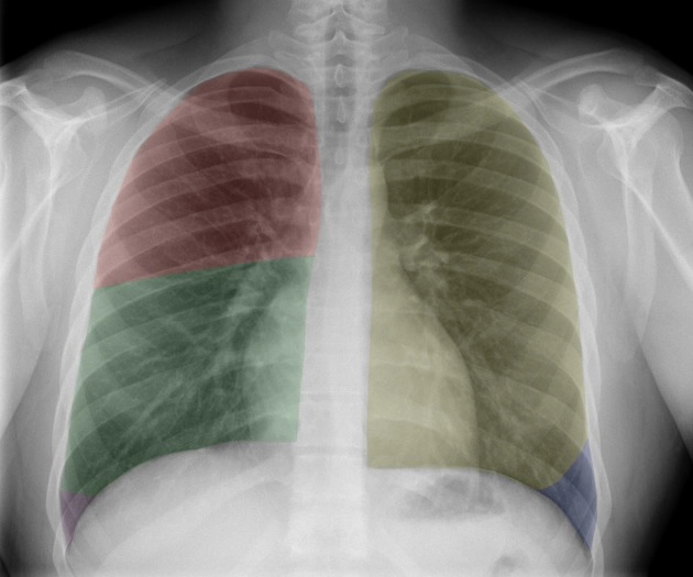 Xẹp thùy dưới phổi trái  (Left lower lobe atelectasis)