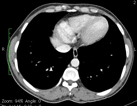 Lao hồi - manh tràng (Ileocecal tuberculosis)