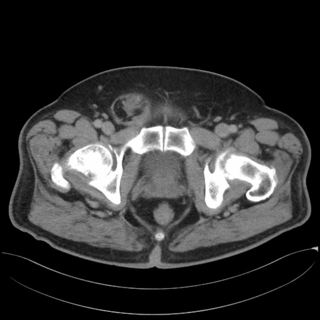 Liposarcoma thừng tinh (Spermatic cord liposarcoma)