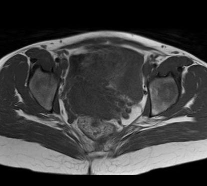 U mạch-nhầy xâm lấn (Aggressive angiomyxoma)