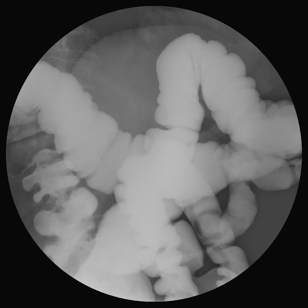 Giun đũa ruột non (Ascariasis)