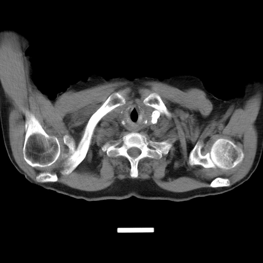 Thoát vị hoành qua khe thực quản (Hiatus Hernia)
