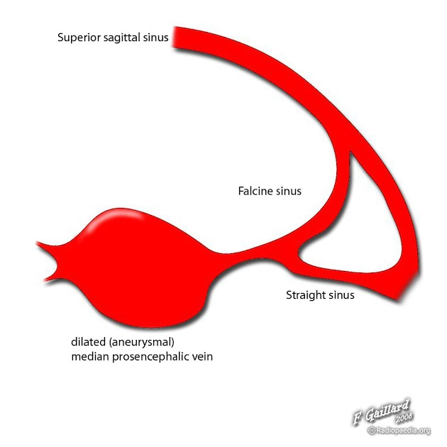 Dị dạng phình tĩnh mạch Galen (Vein of Galen aneurysmal malformations - VGAMs)