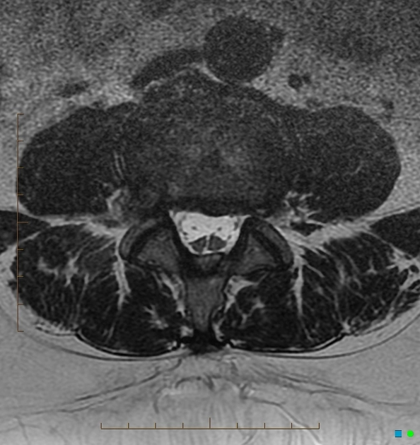 Hội chứng tủy sống bám thấp (Tethered cord syndrome)