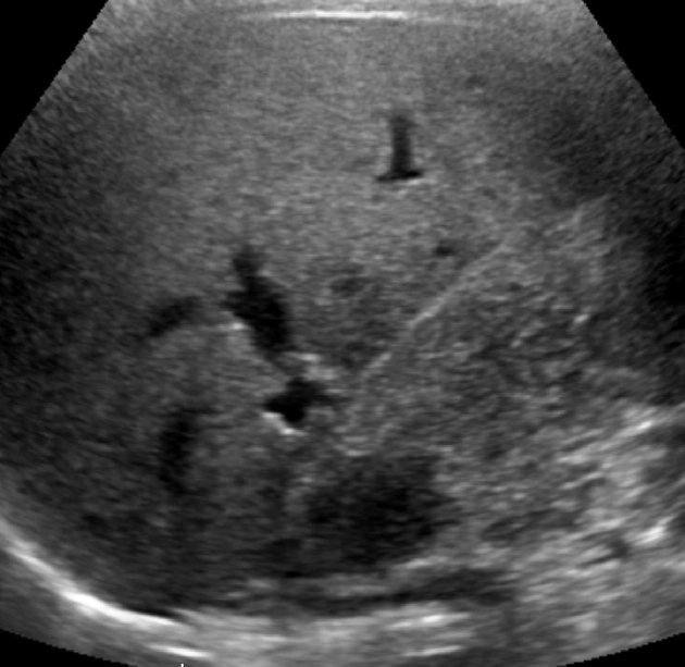 U di căn túi mật (Gallbladder metastases)