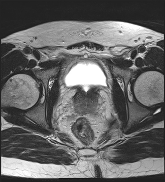 Sỏi túi tinh (Seminal vesicle stones)