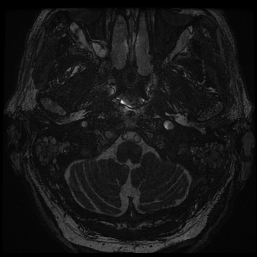 Viêm mê nhĩ (Labyrinthitis)