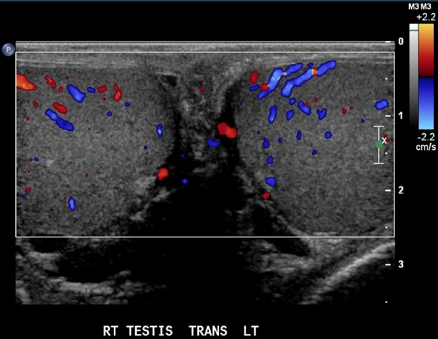Lymphoma tinh hoàn (Testicular lymphoma)