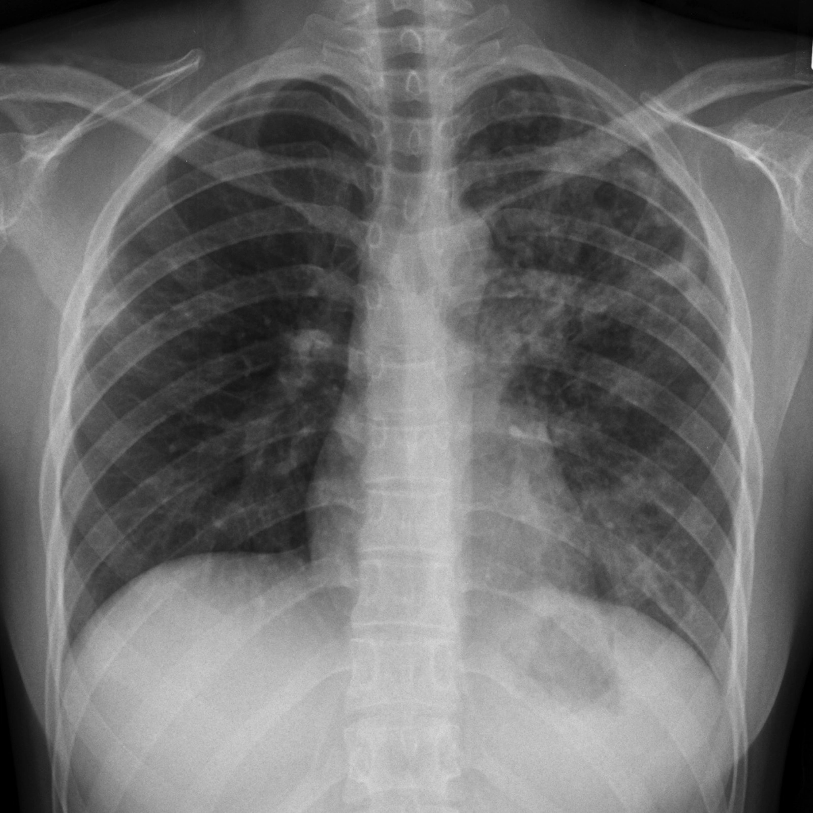 Lao phổi sau sơ nhiễm (Post-primary Pulmonary Tuberculosis)