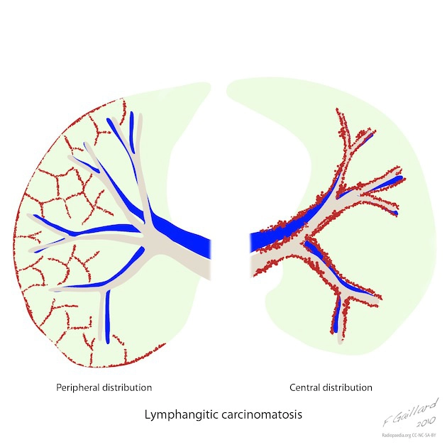 Di căn theo đường bạch huyết (Lymphangitic carcinomatosis)