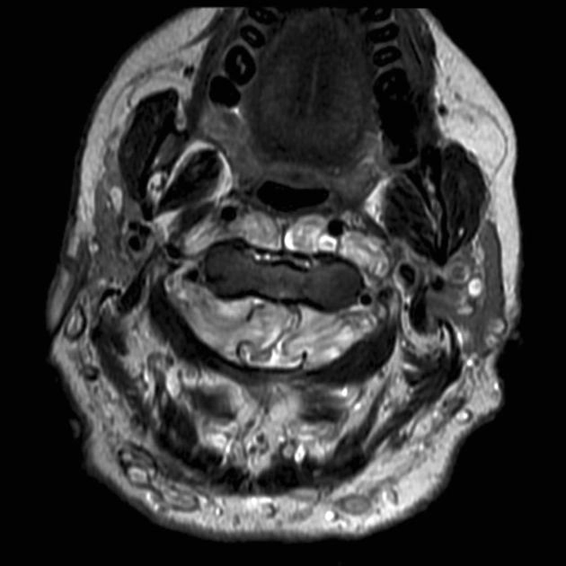 U sợi thần kinh cột sống (Spinal neurofibroma)