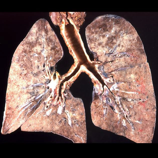 Viêm phổi do nấm Pneumocystis jirovecii (PJP) 