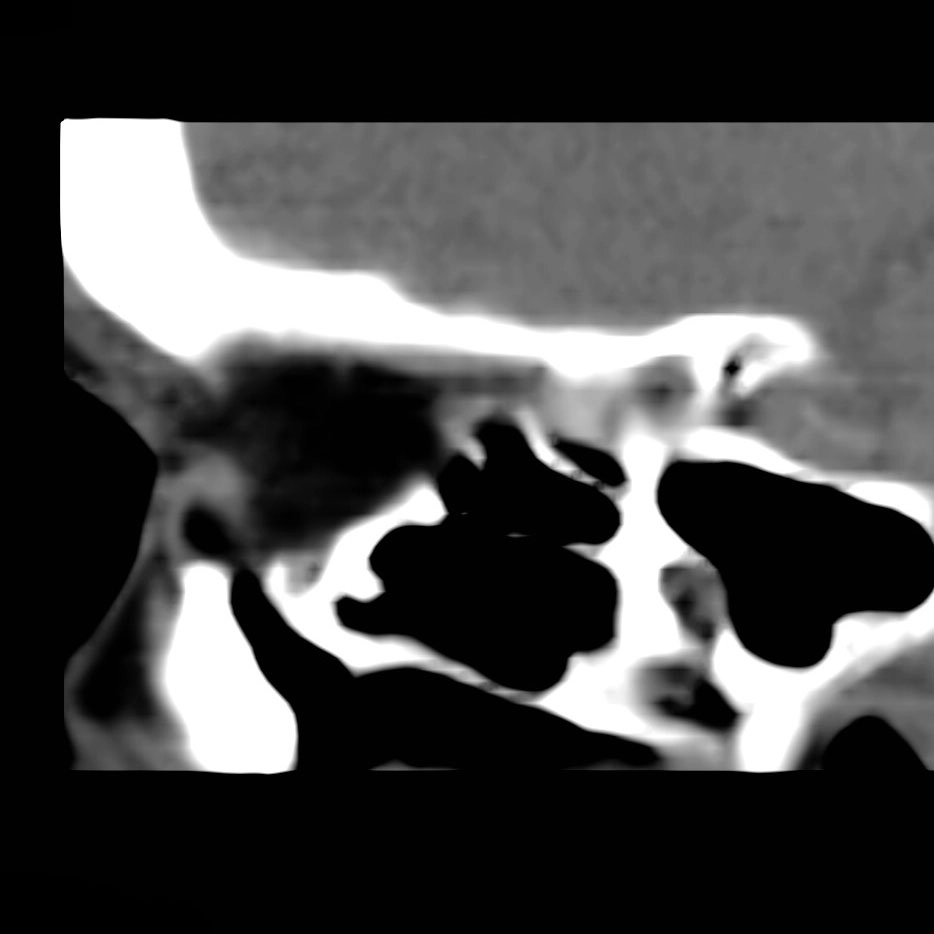 Lymphoma mắt (Orbital lymphoma)