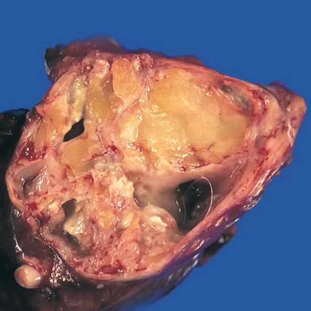 U quái trung thất (Mediastinal Teratoma)