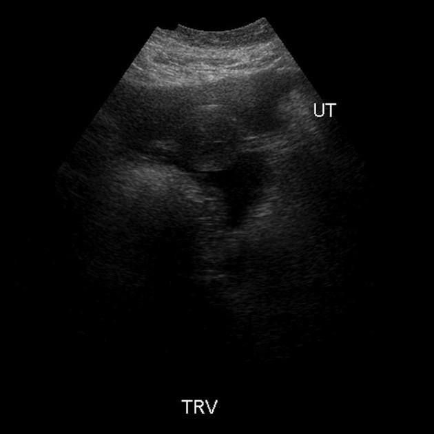 U quái không trưởng thành của buồng trứng (Immature ovarian teratoma)