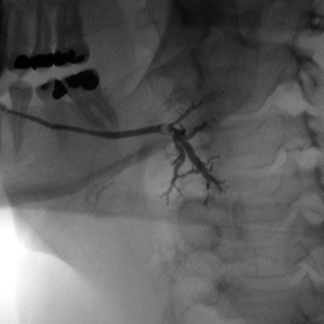 Giãn ống tuyến nước bọt (Sialectasis)