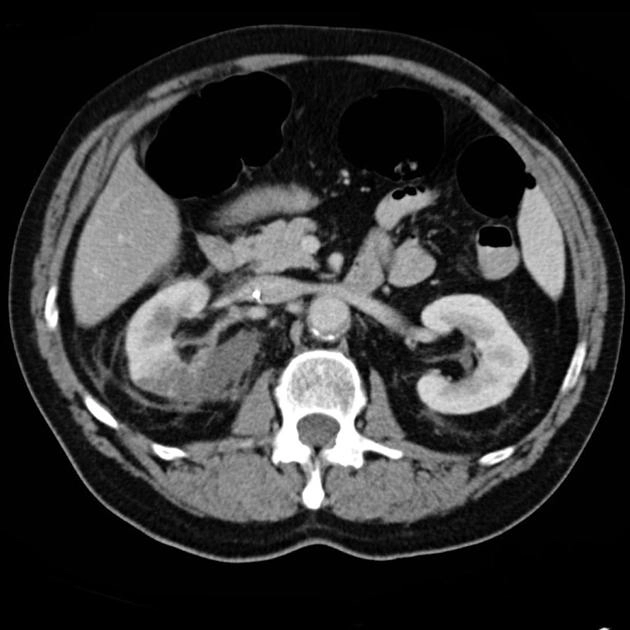 Tắc động mạch thận (Renal artery occlusion)
