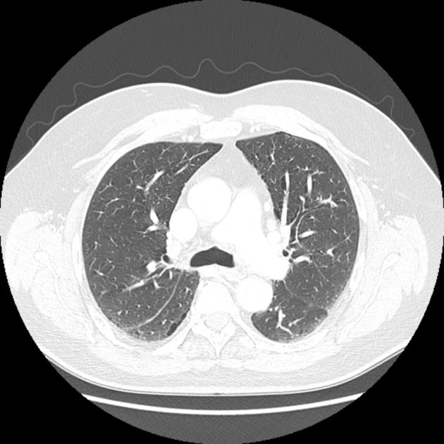 Khí phế thũng cạnh vách (Paraseptal Emphysema)